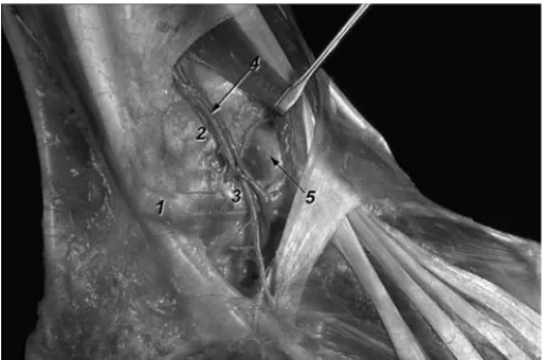 Figura 2. Disección de la región lateral del tobillo. Retractor recha- recha-zando la musculatura anterior de la pierna