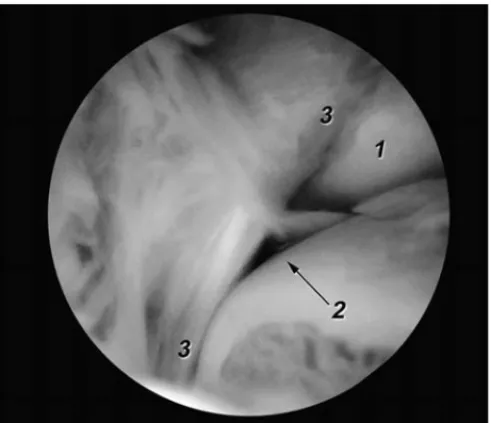 Figura 4. Imagen artroscópica del fascículo distal del ligamento tibio- tibio-fibular anterior obtenida a través del portal anterolateral