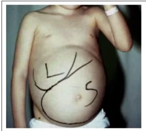 Figura 9: Nen amb la malaltia de Gaucher tipus I on és fa evident l’hepatoesplenomegàlia (imatge de Barranger Therapy review).