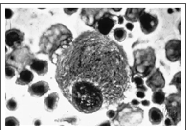 Figura 10: Macròfag carregat de lípids o “cèl·lula de Gaucher”. Són grans i poden ser mono o multinucleades