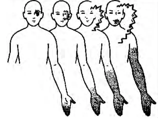 Figura  2.  Representació  de  l’aura  visual  i  sensitiva  al  llarg  del  temps.  L’aura  visual  es  presenta sovint en forma de figures en  ziga-zaga  en  el  punt  de  fixació,  que  s’estenen  progressivament  cap  a  dreta  o  esquerra  i  adopten 