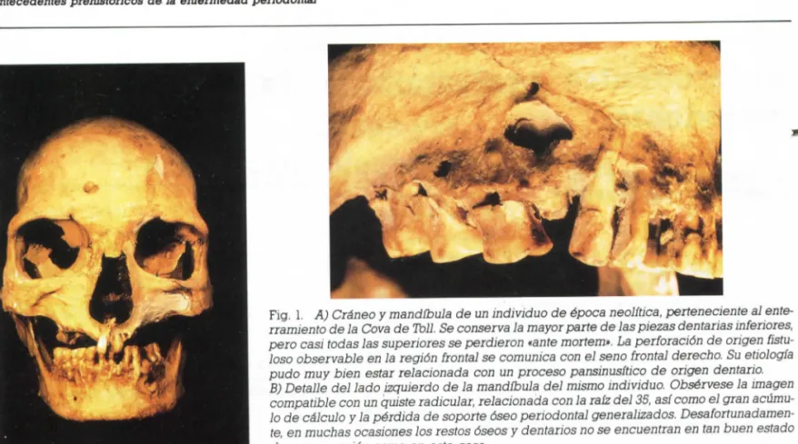 Fig. 1. A) Cráneo y mandíbula de un individuo de época neolítica, perteneciente al ente- ente-rramiento de la Cava de Toll