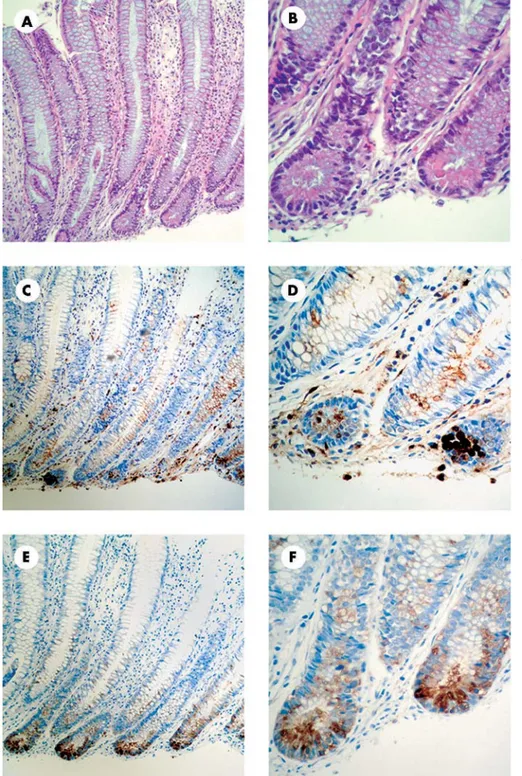 Figure 3 Pancreatitis associated protein (PAP) in the colon of Crohn’s disease (CD) and ulcerative colitis (UC) patients is synthesised in Paneth cells