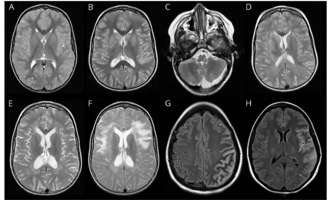 Figure 1 MRI of 2 patients with anti-MOG encephalitis initially misdiagnosed with small vessel CNS vasculitis
