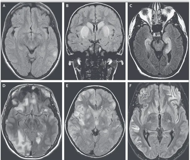 Figure 2.  MRI Findings in Antibody-Mediated Encephalitis.