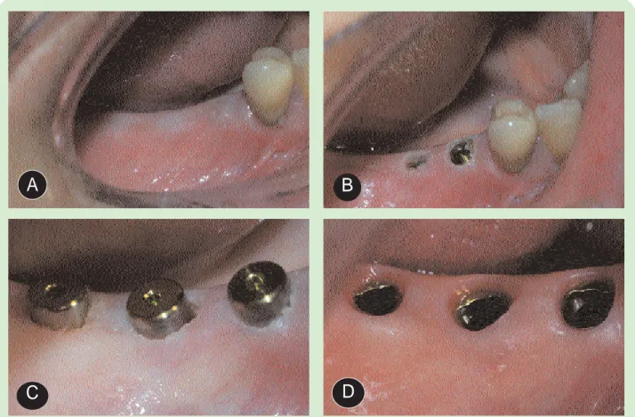 Figura 5. Aplicación del láser de Er,Cr:YSGG en la segunda fase implantológica. (A) Implantes situados en maxilar inferior derecho