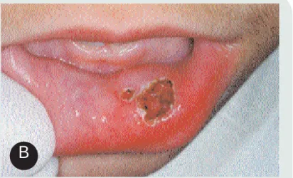 Figura 7. Mucocele. (A) Niña de 8 años de edad que pre- pre-sentaba dos lesiones en la cara interna de la mucosa labial