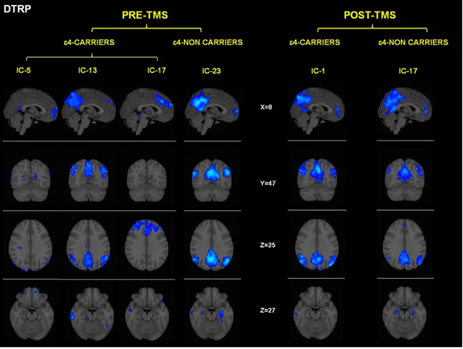 Figure 3. Effects of rTMS in the DMN present in deactivation task-related networks. While both groups exhibited increased temporal correlations between the timecourse of this network and rest condition after rTMS, its activity (intensity of the expression)