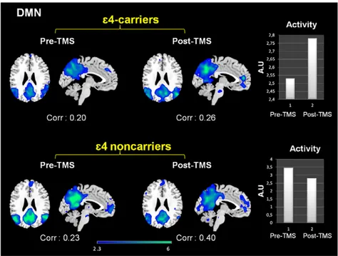 Figure 4. Effects of rTMS in the DMN present in deactivation task-related networks. While both groups exhibited increased temporal correlations between the timecourse of this network and rest condition after rTMS, its activity (intensity of the expression)