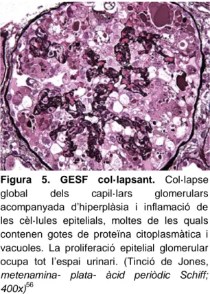 Figura  6.  GESF  “tip  lesion”.  Acumulació 