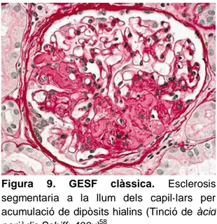 Figura  9.  GESF  clàssica.  Esclerosis  segmentaria  a  la  llum  dels  capil·lars  per  acumulació de dipòsits hialins (Tinció de  àcid  periòdic Schiff; 400x) 58