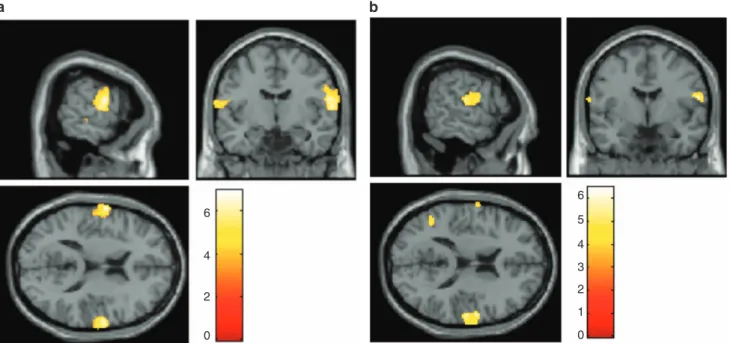 Figure 3. Correlation of regional brain volume with chromatin condensation (CC) after apoptosis induction with staurosporine (STS) in ﬁrst- ﬁrst-episode schizophrenia (FES) and controls