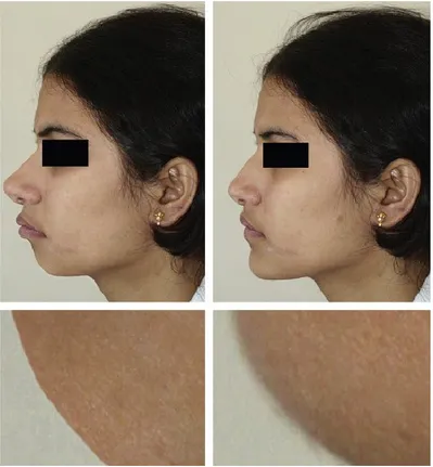 Figure 4: In this case the image was modified digitally to show the changes that can be achieved with  surgical-orthodontic treatment