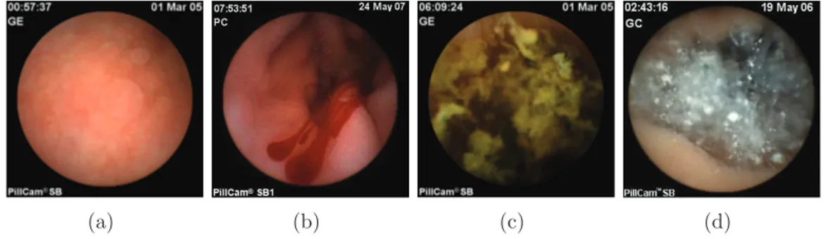 Figure 2.4: Different examples of capsule endoscopy scenarios. (a) Normal small bowel mucosa