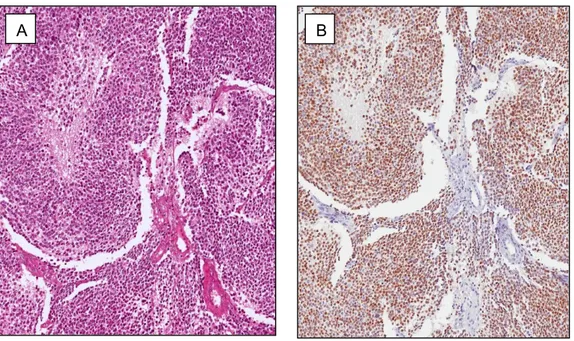 Fig. 6 Poorly differentiated neuroblastoma. 