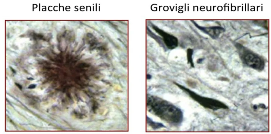 Fig. 2.3 – Reperti anatomopatologi nei cervelli di pazienti con AD 