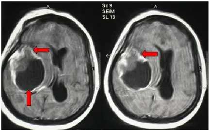 Figura 16. Tipico aspetto di glioblastoma multiforme temporale destro alla RMN in proiezione  assiale