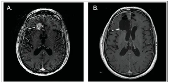 Figura 18. (A) Immagine di Risonanza magnetica nucleare (MRI) prima della resezione della  lesione tumorale; (B dopo intervento chirurgico