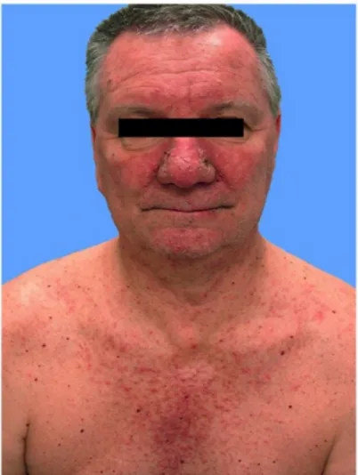 Figure 2.  Clinical presentation of papulopustular rash due to HER inhibitors.  