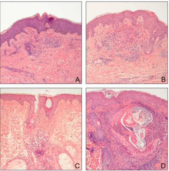 Figure 5. Histologic findings of representative specimens for each HER inhibitor.    A) Skin from a patient on lapatinib exhibiting a mild periadnexal and interstitial  infiltrate  consisting  of  mononuclear  cells  and  neutrophils