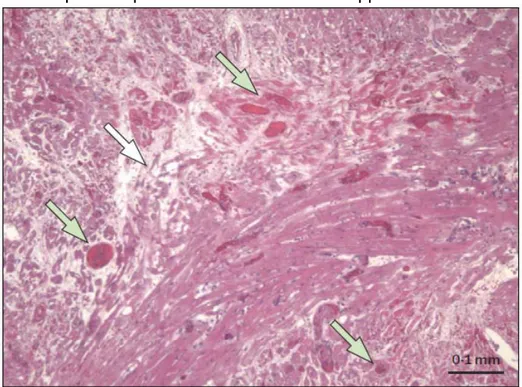 Figure 5: Typical features of thrombotic microangiopathy in a pig heart 6 months  after  heterotopic transplantation into an immunosuppressed baboon 