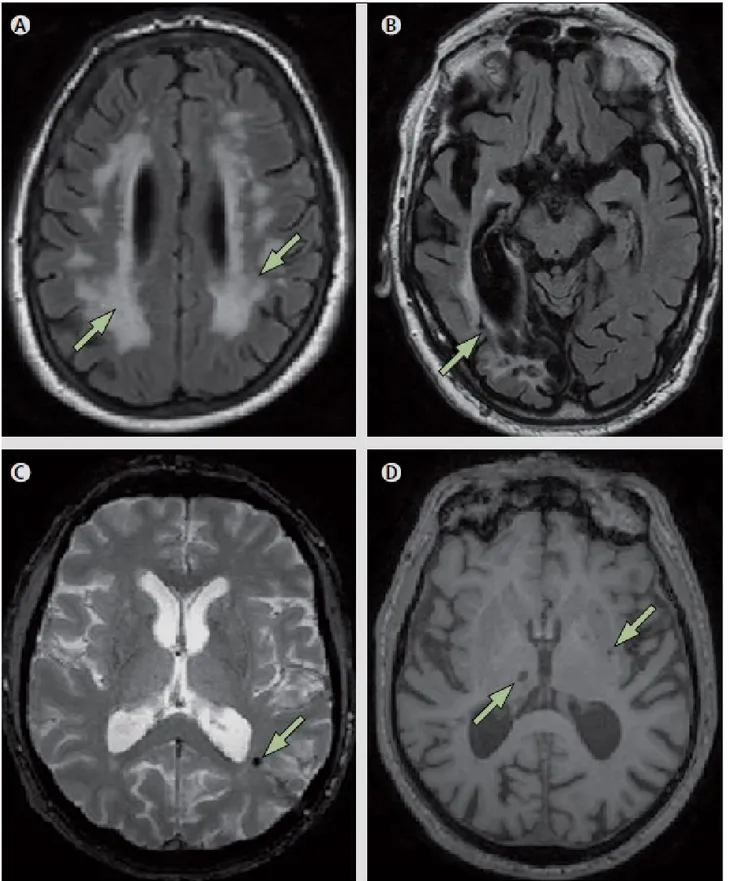 Figure 6. Vascular imaging changes on MRI. 72
