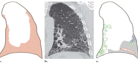 Figura  1.  Distribuzione  (a),  immagine   CT  (b),  e   pattern  CT  (c)  della  UIP