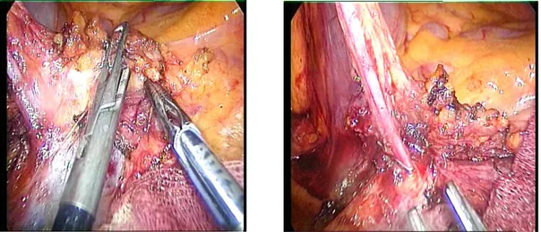 Fig.  6:  Isolamento  e  legatura  dell’arteria  e  vena  ileocolica  all’emergenza  sui  vasi  mesenterici  superiori