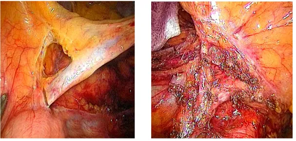 Fig.  8  a)    Isolamento  e  sezione  della  vena    mesenterica  inferiore;  b)  Isolamento  e  sezione  dell’arteria mesenterica inferiore, colica sinistra e rettale superiore