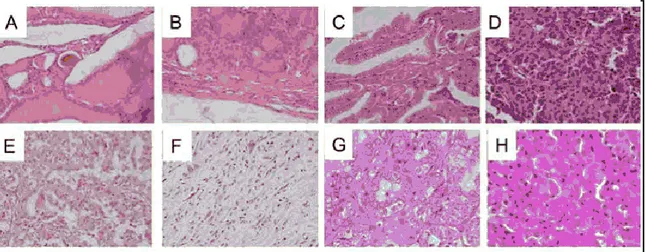 Figure  1:  Istotypes  of  human  thyroid  cancer.  A,  Normal  Thyroid.  B,  Adenoma