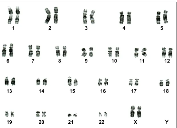 Fig. 37: Cariotipo con l’inversione pericentrica del cromosoma 9 con bandeggio Q. L’immagine è stata  ottenuta  mediante  inversione  della  colorazione  standard  (cioè  cromosomi  di  colore  chiaro  su  fondo  nero)