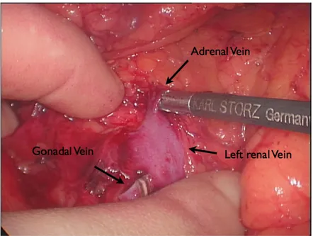 Fig. 4. Intraoperative picture: Left renal vein, Gonadal vein (already transected), Adrenal vein.