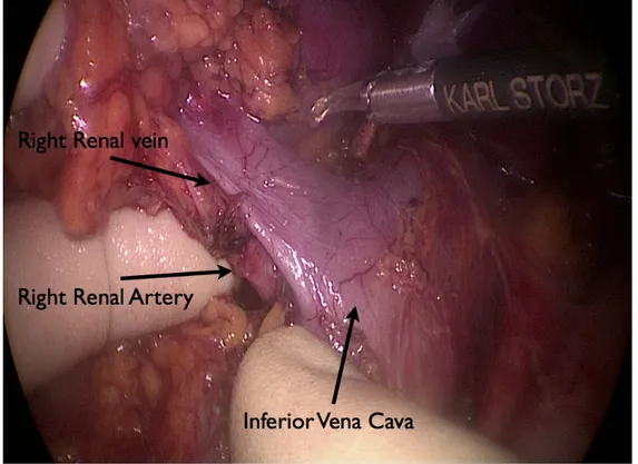 Fig. 7: Intraoperative picture: dissection of the right kidney hilum