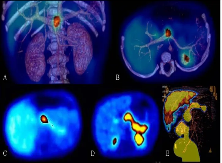 Figure 9. Abdominal 18F-fluoro-L-DOPA PET-scan imaging in HI. Focal form (A, B, C): PET-scan localizes 