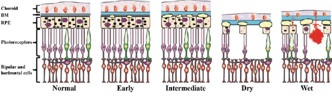 Figure 4: Diagram of the outer layers of the human central retina in normal and in AMD (Tan et al