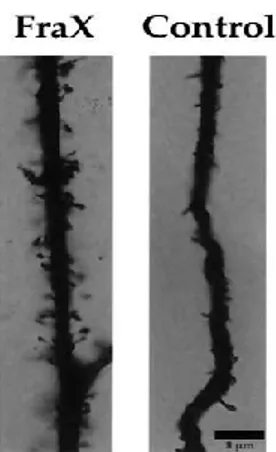 Figure 1. Dendritic spines of fragile X neurons.   Adapted from Irwin et al., 2001 