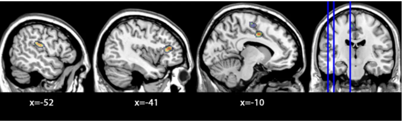 Figure 2: Grey matter areas where ICD patients show volume reduction if compared to PD No-ICD patients and HC.
