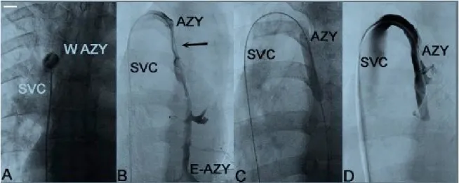 Fig. 2.  A) flebografia selettiva che mostra un'ostruzione membranosa a  livello dello sbocco della vena azygos nella vena cava superiore  (SVC)