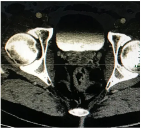 Foto 1. Segni di flogosi parietale delle vescicole seminali (enhancement post mdc) in paziente con concomitante IBD