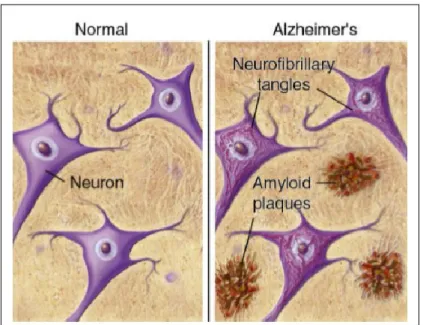 Figura 6. Placche neuritiche e Grovigli neurofibrillari in condizioni  normali ed in presenza di AD