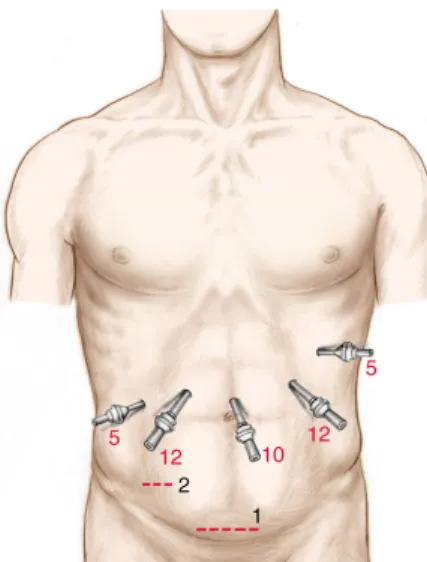 Figura  10:  Posizione  alternativa  del  paziente  ed  inserimento  dei  trocars  per  l’approccio  laparoscopico  al  segmento  6