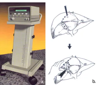 Figura 24:  (a) Harmonic  scalpel  (Ultracision ® ,  Ethicon   Endo-Surgery  Inc.,  Cincinnati,  OH,  USA)