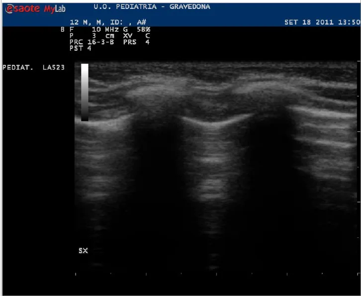 Figura 3a – Immagine normale del polmone pediatrico  