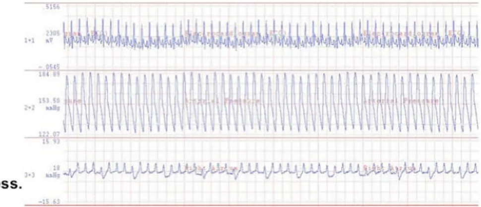 Figura  5. Tracciato EKG, pressione arteriosa ed atriale destra attestante il ritorno spontaneo della  circolazione (ROSC) dopo rianimazione cardiopolmonare
