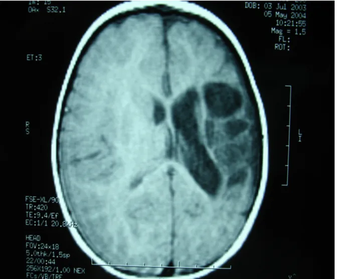 Figura  1: l'esame   RM evidenzia  una  vasta  area  malacica   di  aspetto triangolare nel decorso dell'arteria cerebrale media di  sinistra.