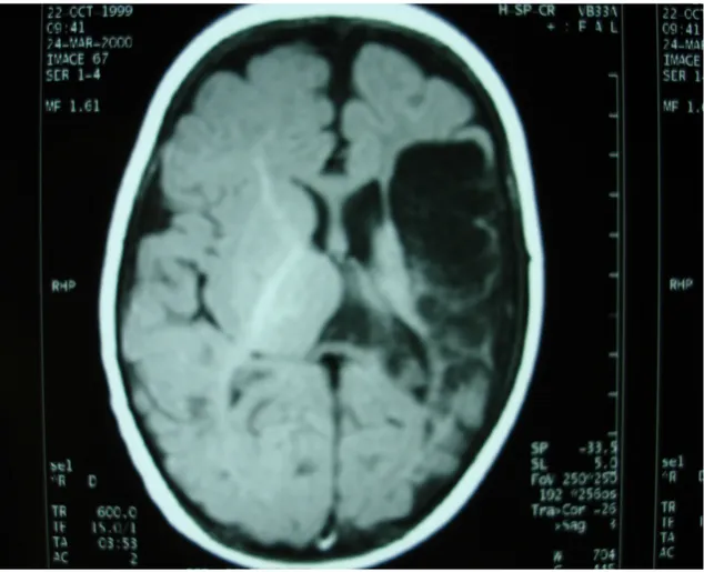 Figura   2:   presenza   di   cavità   cistiche   pluriconcamerate  stabilizzate da esiti di trombosi dell'arteria cerebrale media di  sinistra all'esame RM.