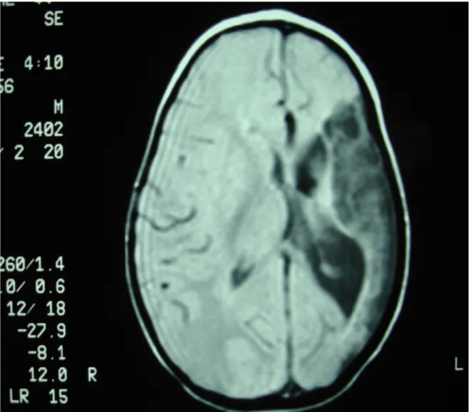 Figura   3:   l’esame   RM   encefalo   mostra   iposviluppo  dell’emisfero   cerebrale   di   sinistra   da   ostruzione   dei   rami  terminali della cerebrale media