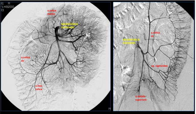 Fig 2: immagini angiografiche selettive del circolo arterioso della mesenterica  superiore e inferiore