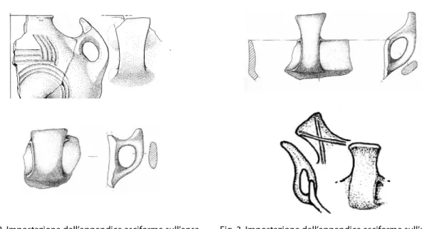 Fig. 3. Impostazione dell’appendice asciforme sull’ansa a  nastro con ampia luce verticale 
