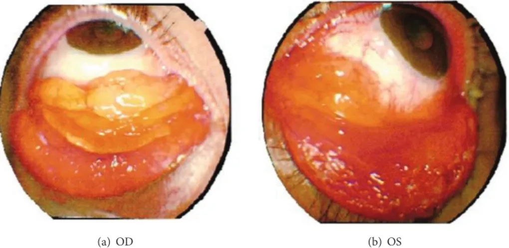 Figure 1: External photos of right (a) and left (b) eye showing bilateral yellow-pink conjunctival mass in the lower fornices with subconjunctival hemorrhage and left eye ectropion.